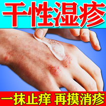 干性湿疹止痒成人儿童去皮肤干燥瘙痒红肿根外用热痱子屁股湿疹膏